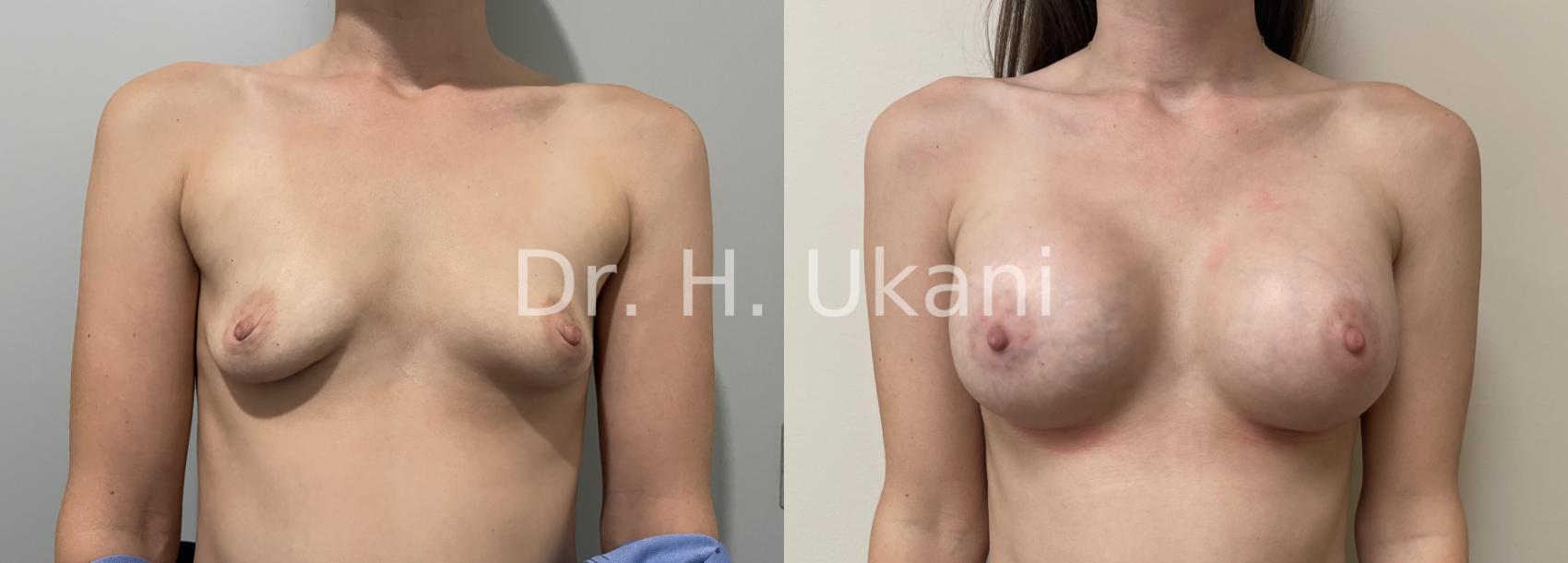 Before & After Breast Augmentation Case 24 Front View in Port Moody, BC