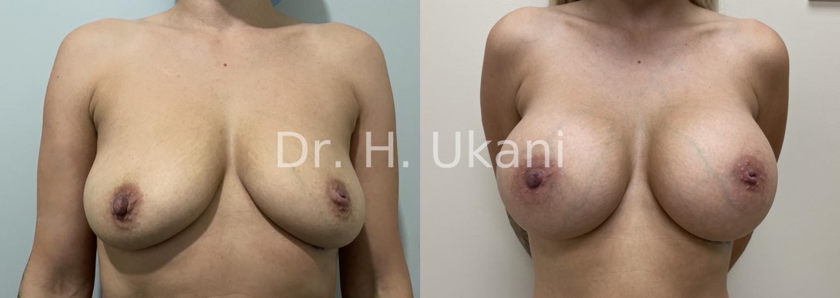 Before & After Breast Augmentation Case 27 Front View in Port Moody, BC