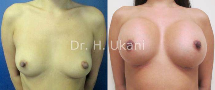 Before & After Breast Augmentation Case 10 View #1 View in Port Moody, BC