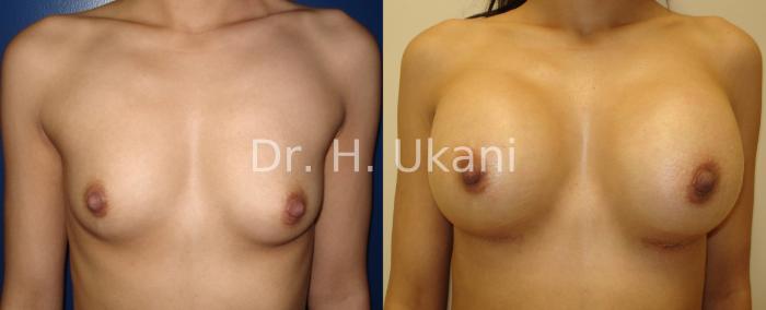 Before & After Breast Augmentation Case 11 View #1 View in Port Moody, BC