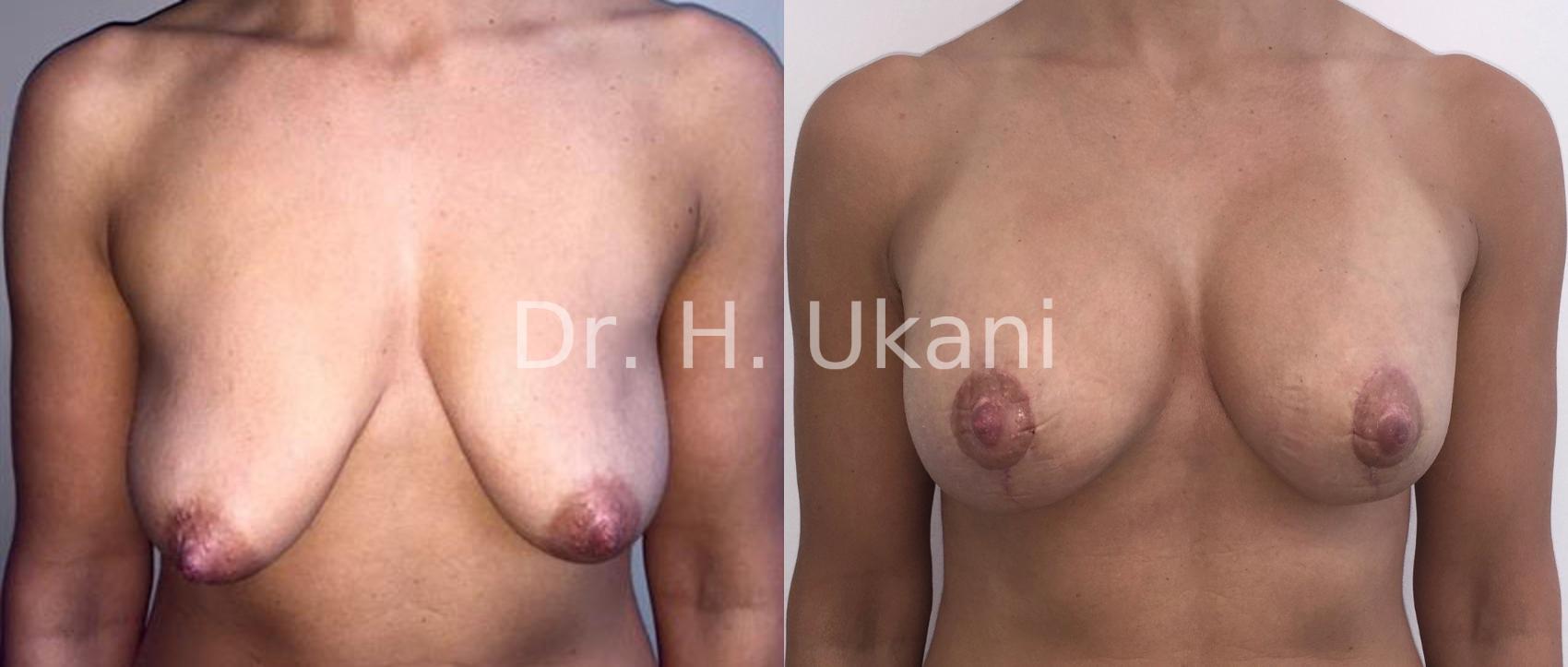 Before & After Breast Augmentation Case 12 View #1 View in Port Moody, BC