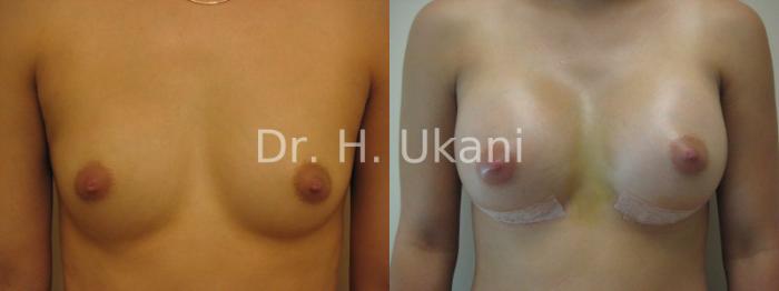 Before & After Breast Augmentation Case 13 View #1 View in Port Moody, BC