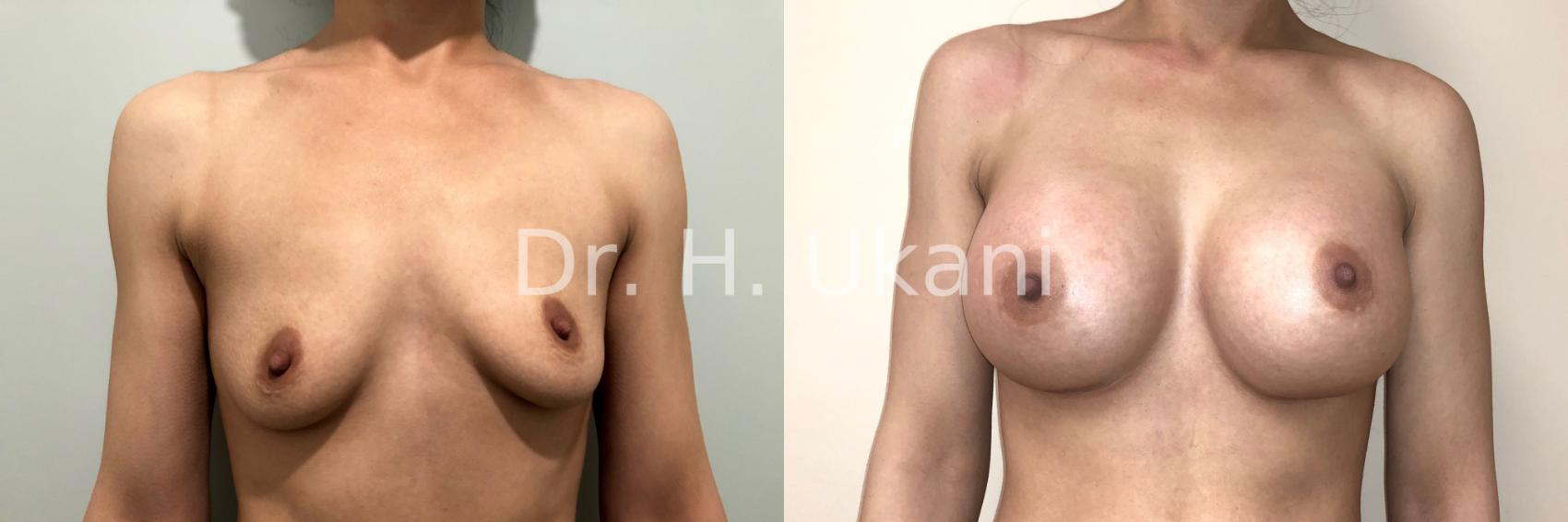 Before & After Breast Augmentation Case 16 Front View in Port Moody, BC