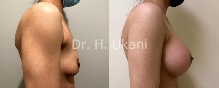 Before & After Breast Augmentation Case 16 Right Side View in Port Moody, BC