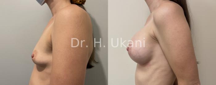 Before & After Breast Augmentation Case 24 Left Side View in Port Moody, BC