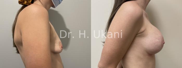 Before & After Breast Augmentation Case 24 Right Side View in Port Moody, BC