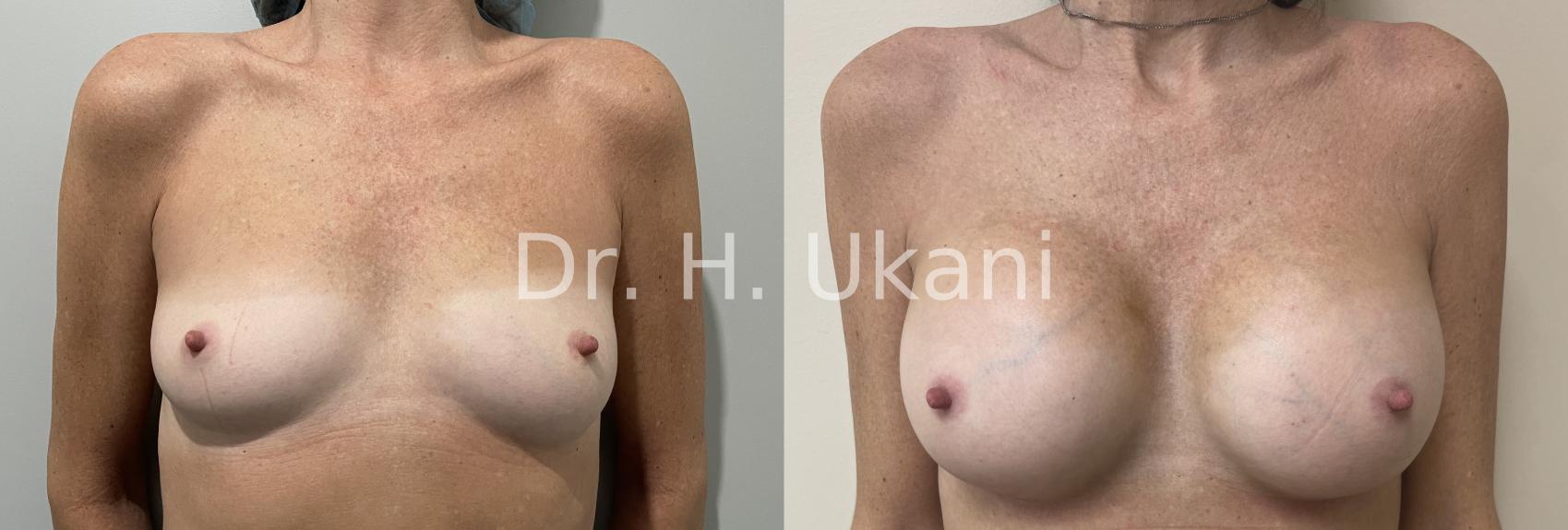 Before & After Breast Augmentation Case 25 Front View in Port Moody, BC