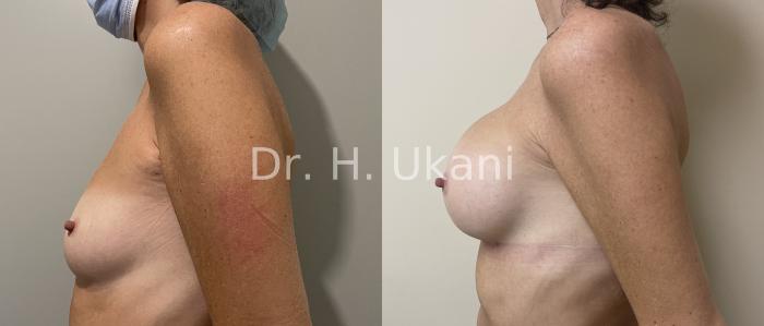 Before & After Breast Augmentation Case 25 Left Side View in Port Moody, BC