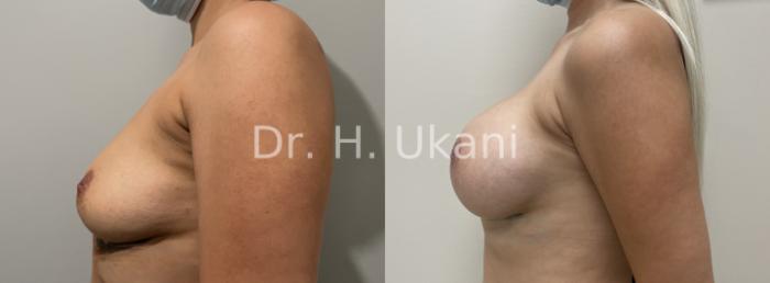 Before & After Breast Augmentation Case 27 Left Side View in Port Moody, BC