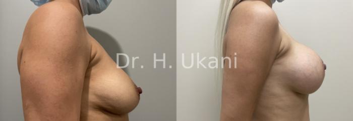Before & After Breast Augmentation Case 27 Right Side View in Port Moody, BC