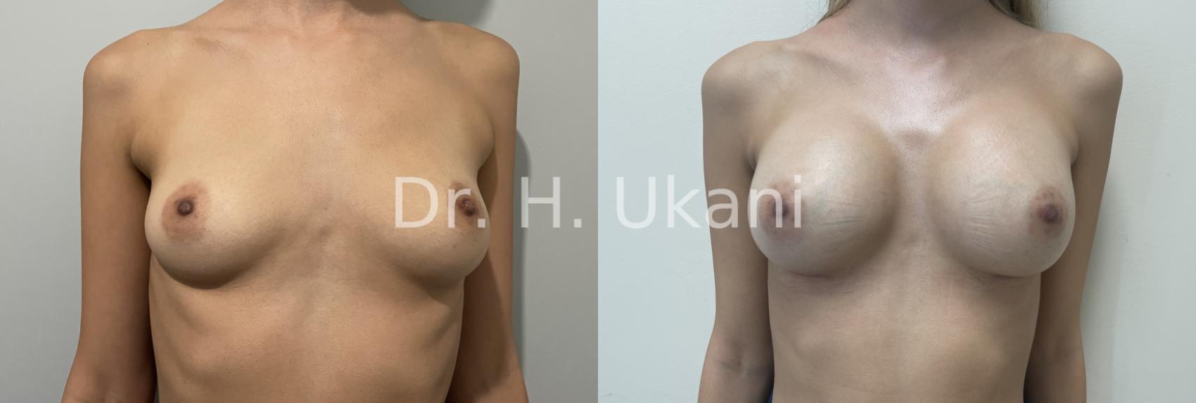 Before & After Breast Augmentation Case 28 Front View in Port Moody, BC