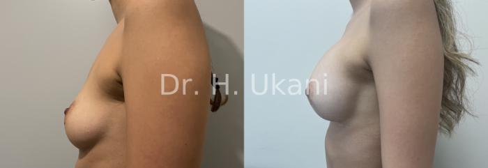 Before & After Breast Augmentation Case 28 Left Side View in Port Moody, BC