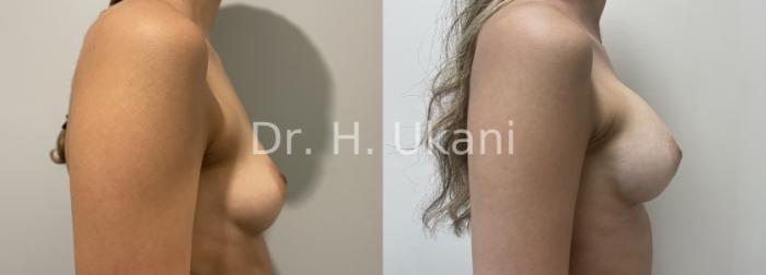 Before & After Breast Augmentation Case 28 Right Side View in Port Moody, BC
