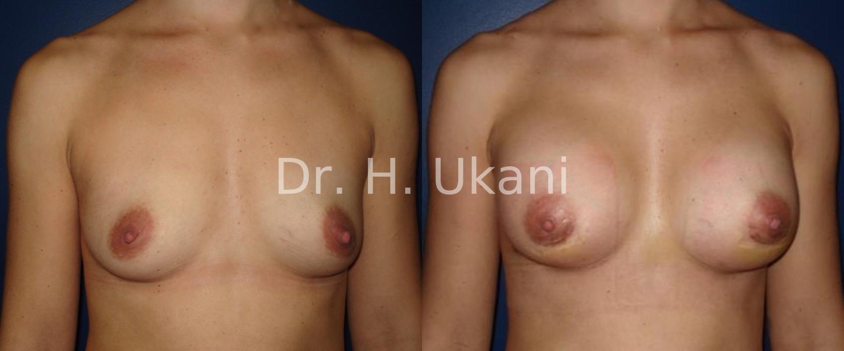 Before & After Breast Augmentation Case 9 View #1 View in Port Moody, BC
