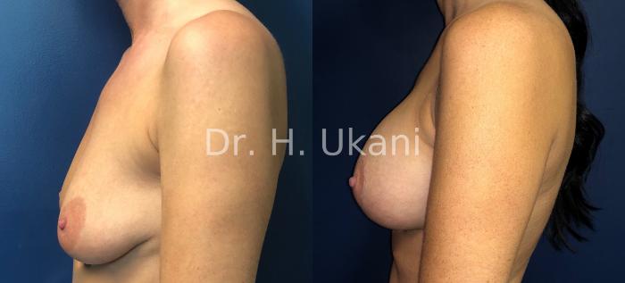 Before & After Breast Augmentation and Lift Case 14 Left Side View in Port Moody, BC