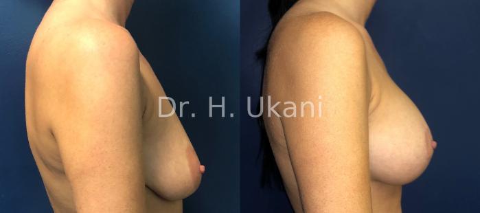 Before & After Breast Augmentation and Lift Case 14 Right Side View in Port Moody, BC