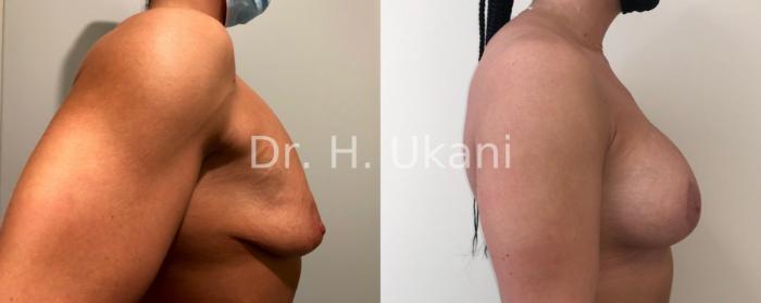 Before & After Breast Augmentation and Lift Case 17 Right Side View in Port Moody, BC