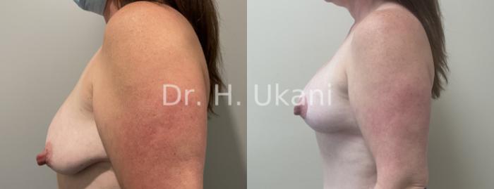 Before & After Breast Augmentation and Lift Case 23 Left Side View in Port Moody, BC