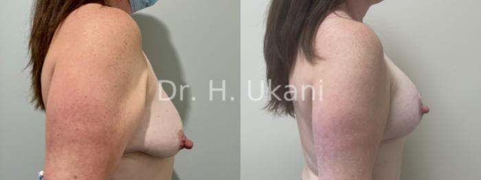 Before & After Breast Augmentation and Lift Case 23 Right Side View in Port Moody, BC