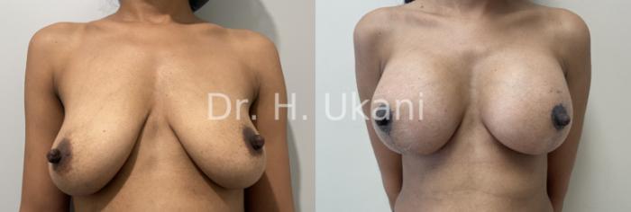 Before & After Breast Lift Case 26 Front View in Port Moody, BC