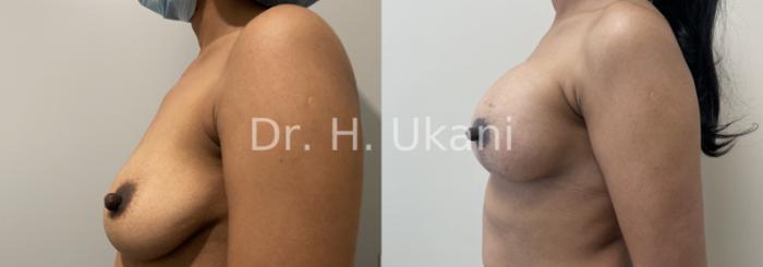 Before & After Breast Lift Case 26 Left Side View in Port Moody, BC