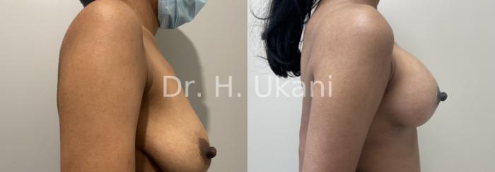 Before & After Breast Augmentation and Lift Case 26 Right Side View in Port Moody, BC