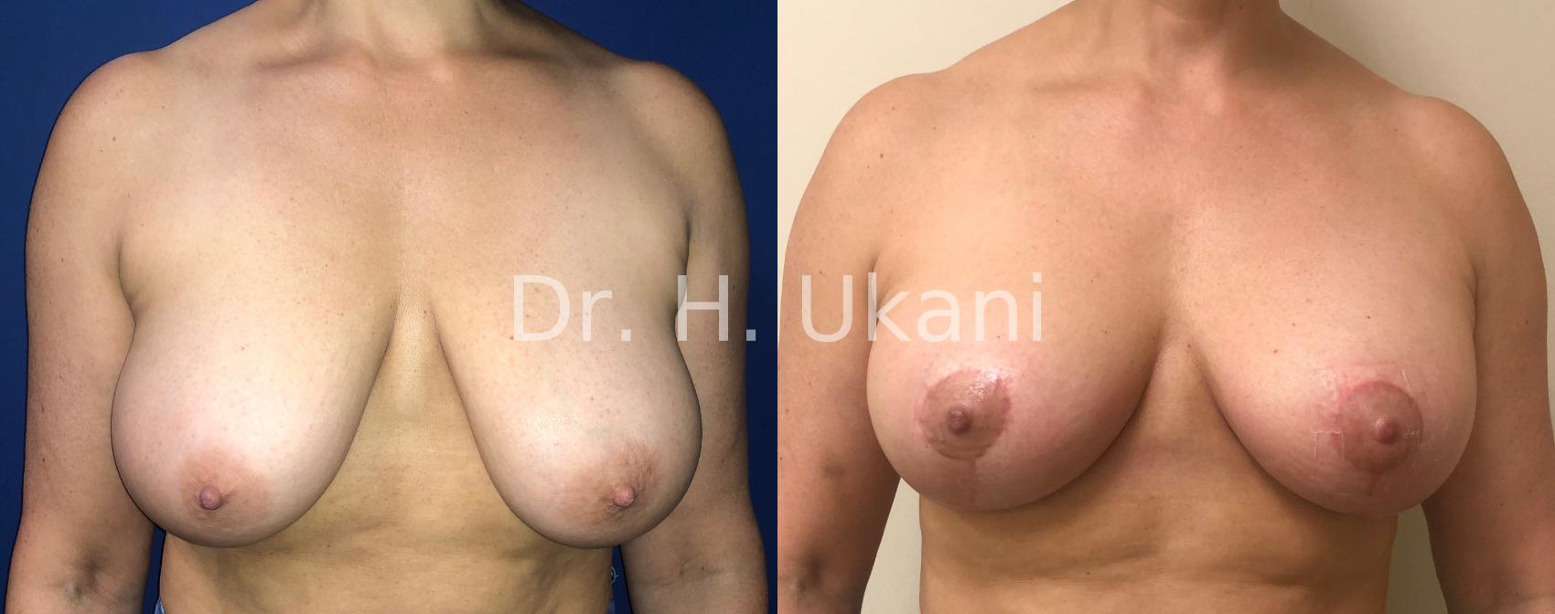 Breast Lift with a lollipop scar