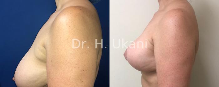 Before & After Breast Lift Case 15 Left Side View in Port Moody, BC