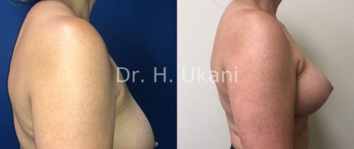 Before & After Breast Lift Case 15 Right Side View in Port Moody, BC