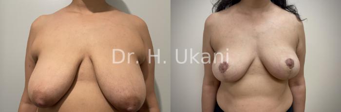 Before & After Breast Lift Case 30 Front View in Port Moody, BC