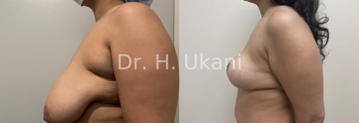 Before & After Breast Lift Case 30 Left Side View in Port Moody, BC