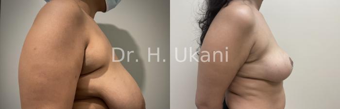 Before & After Liposuction Case 30 Right Side View in Port Moody, BC