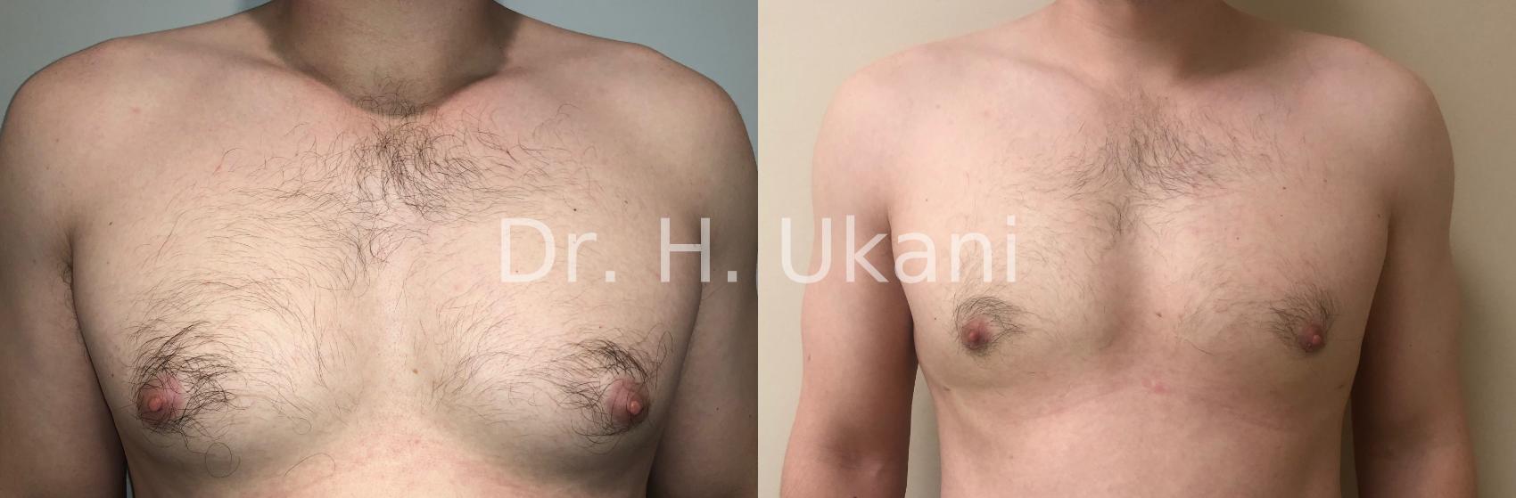 Before & After Male Chest Case 19 Front View in Port Moody, BC