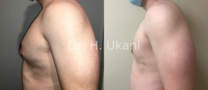 Before & After Liposuction Case 19 Left Side View in Port Moody, BC
