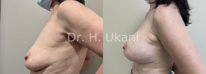 Before & After Ruptured Implant Case 29 Left Side View in Port Moody, BC