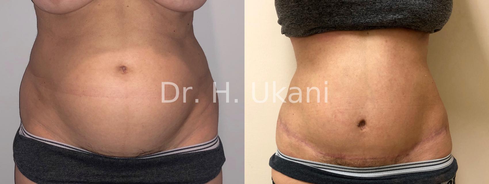 Abdominoplasty with umbilical float