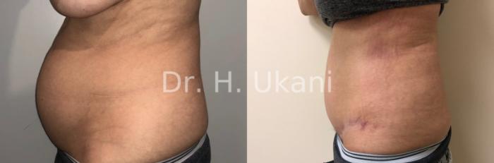 Before & After Tummy Tuck Case 18 Left Side View in Port Moody, BC