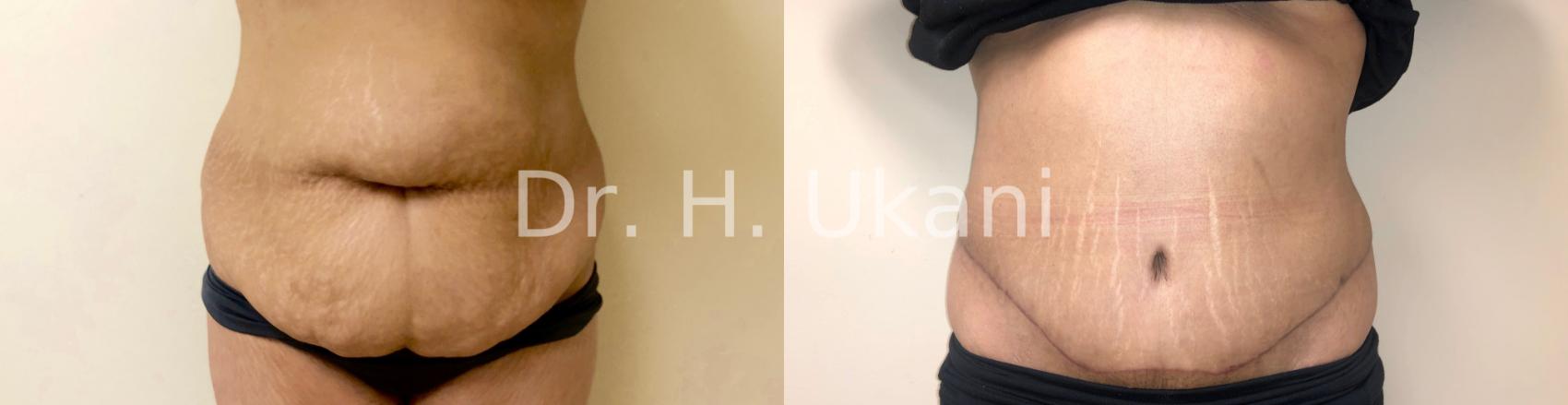 Before & After Tummy Tuck Case 20 Front View in Port Moody, BC