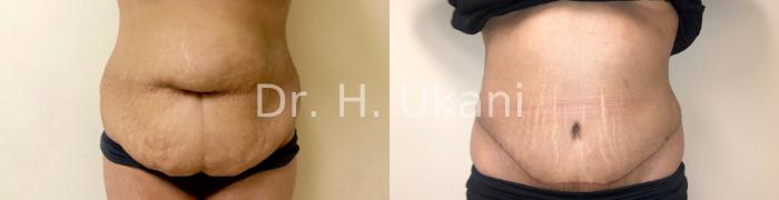 Liposuction Before and After Photo Gallery, Port Moody, BC