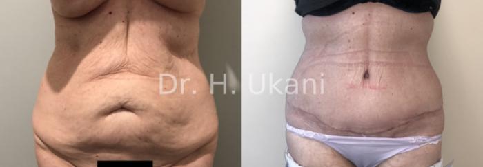Before & After Liposuction Case 22 Front View in Port Moody, BC