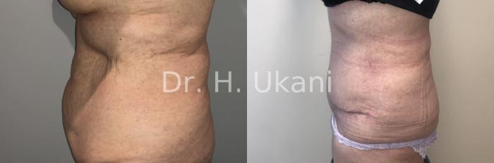 Before & After Liposuction Case 22 Left Side View in Port Moody, BC